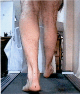 Le tapis roulant est un bon outils diagnostic